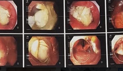 Hình ảnh xương gà mắc trong cổ họng bệnh nhân (Ảnh - BVCC) 