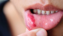 Tưởng chỉ là nhiệt miệng, nào ngờ phát hiện đang mắc ung thư lưỡi 