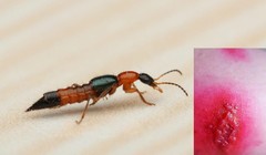 Vết phỏng da do kiến ba khoang cắn
