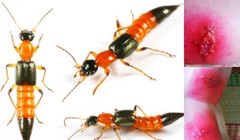 Những vết cắn của kiến ba khoang gây ra tổn thương nghiêm trọng cho da