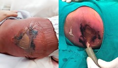 Em bé sơ sinh bị bỏng nặng, hoại tử da vì mẹ cho nằm than
