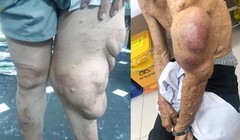 Cắt bỏ khối u sợi thần kinh khổng lồ khỏi cơ thể người đàn ông.