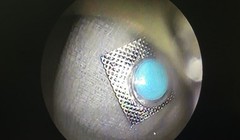 Bệnh nhân nuốt vỏ thuốc như dao bén vào thực quản. Ảnh: BV