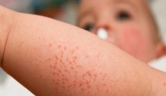 Bé trai 18 tháng tuổi bị sùi mào gà do ba vệ sinh không cẩn thận. Ảnh: Internet