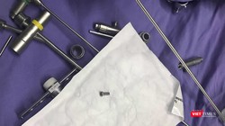 Đinh vít nằm ở đường thở của bệnh nhân nhi tên N. ở Quảng Nam sau khi nội soi gắp ra.