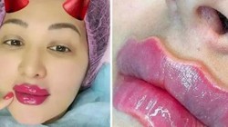 Đẹp thì mỗi người có quan niệm khác nhau nhưng nguy cơ mà “Devil's Lips” gây ra cho sức khỏe là có thật.