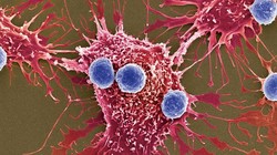 Liệu pháp mới được thông qua đột phá ở chỗ sử dụng các tế bào T đã chỉnh gen (xanh dương) để tấn công tế bào ung thư (màu đỏ) (Ảnh: Science Source)