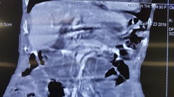 Hình ảnh chụp CT của bệnh nhân