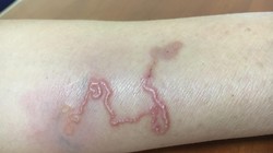 "Đường hầm" do ấu trùng giun chó mèo "đào" dưới da