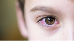 Dịch đau mắt đỏ đang bùng phát 