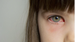 Hôm nay, Sở Y tế TP HCM công bố đã xác định được tác nhân gây bệnh đau mắt đỏ trên địa bàn