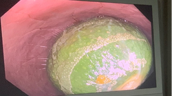 Nam thanh niên nhét con lươn dài 65cm vào hậu môn, phải mổ cấp cứu