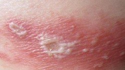  Cô đơn, căng thẳng làm tăng nguy cơ mắc zona thần kinh