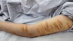 Người trẻ rủ nhau tự gây thương tích, bác sĩ chỉ ra nguyên nhân kèm lời khuyên