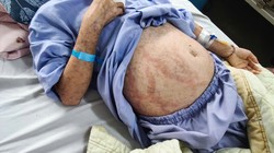 Tự mua thuốc uống, cô gái bị hoại tử da, nhiễm trùng toàn thân