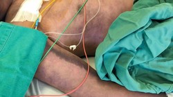 Người đàn ông rơi vào nguy kịch sau khi ăn lòng lợn