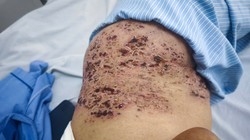 Zona thần kinh ở người cao tuổi dễ bị biến chứng nặng 