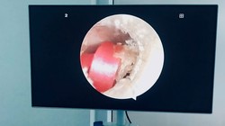 Sợi dây buộc tóc suýt làm bé gái 6 tuổi thủng màng nhĩ