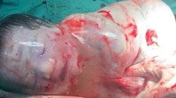 Kỳ diệu bé trai sinh ra trong “bọc điều” ở Hà Nội, chỉ xuất hiện 1/80.000 ca