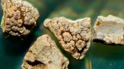 Những mảnh nhỏ của sỏi thận. Ảnh: News Scientist