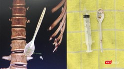 Hình ảnh thìa nhựa bên trong đường tiêu hoá của bệnh nhân từ phim chụp và sau khi lấy ra ngoài