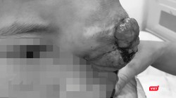 Bệnh nhân L.M.Q. (9 tuổi, dân tộc Thái, quê ở Sơn La) với khối u hốc mắt từ nhỏ trước khi phẫu thuật