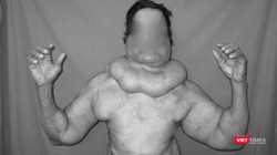 Bệnh nhân mắc chứng u mỡ đối xứng hiếm gặp