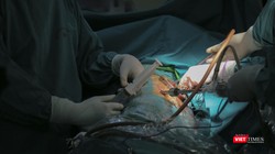 Ê-kíp bác sĩ phẫu thuật do Ths.Bs Nguyễn Văn Lâm – Khoa Ngoại tổng hợp, Bệnh viện đa khoa Đức Giang sử dụng kỹ thuật nội soi để bóc ổ cặn màng phổi nghi do di chứng COVID-19 cho bệnh nhân