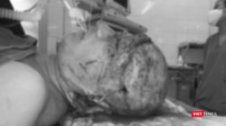 Bệnh nhân bị lột toàn bộ da đầu, 2 tai, mí mắt