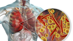 Virus Mycoplasma pneumoniae gây viêm phổi ở trẻ (ảnh BVCC)