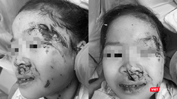 Bệnh nhi Nguyễn Ánh L. bị chó cắn tổn thương nặng vùng đầu và mặt