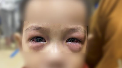 Trẻ bị đau mắt đỏ và gặp biến chứng nặng (ảnh BVCC)