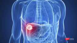 Ở Việt Nam, tử vong do ung thư gan gấp 3,8 lần tử vong do tai nạn giao thông (ảnh BVCC)