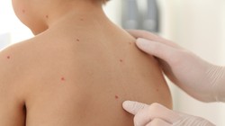 Các nốt phỏng nước nổi khắp cơ thể là biểu hiện điển hình của thủy đậu