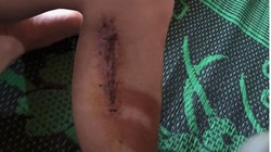 Vì sao chuyên gia dự báo sẽ có thêm người mắc giun rồng ở Việt Nam?