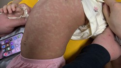 Nhiều trẻ mắc bệnh sởi những ngày đầu năm