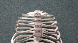 Ca ghép xương ngực nhân tạo bằng công nghệ in 3D đầu tiên tại Hàn Quốc. Ảnh: koreabiomed.com
