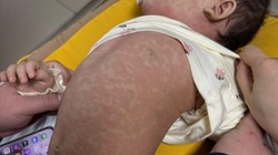 Hơn 1.500 người mắc sởi dịp Tết, dự báo dịch tiếp tục diễn biến phức tạp 