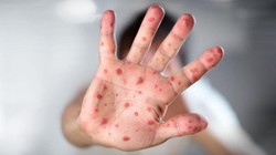 Nguy cơ bùng phát dịch sởi ở Hà Nội và TPHCM