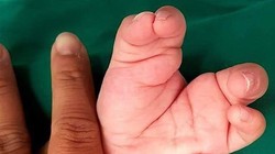 Bé trai hai tuổi vừa được các bác sĩ BV Nhi Đồng cứu thoát khỏi chứng tay chân càng cua 