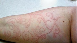 Bệnh lý da vẽ nổi rất hay gặp ở trẻ em, đặc biệt trong mùa mưa (ảnh minh họa)