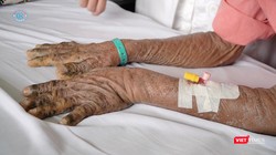 Hai tay của một nạn nhân nhiễm độc thuốc nam điều trị tại Bệnh viện Chợ Rẫy