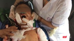 Một trường hợp trẻ em bị thương nặng do chó nhà tấn công