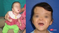 Bệnh nhi trước và sau khi phẫu thuật