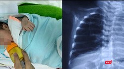 Em bé D.A bị dị dạng đường dẫn khí phổi bẩm sinh