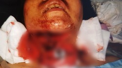 Chị P. bị chấn thương nặng ở vùng cổ