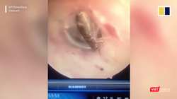 Một con gián nhỏ còn sống đang "vui chơi" trong tai của bệnh nhân