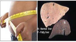 Gan nhiễm mỡ là hậu quả của chế độ sinh hoạt không hợp lý và sử dụng nhiều rượu, bia.