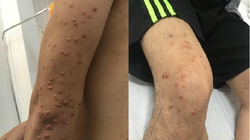 Các nốt sần đặc nhân vàng nổi dày đặc trên tay và chân của anh K.