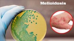 Ảnh minh họa bệnh Melioidosis (hay còn gọi là bệnh Whitmore).